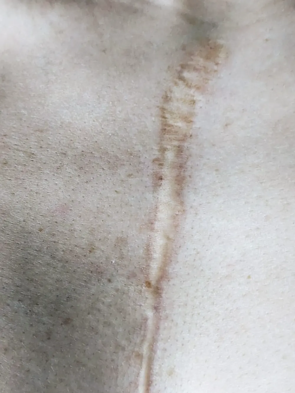 Blizna po sternotomii przed terapią — przebarwiona, nierówna, z wyraźnym reliefem